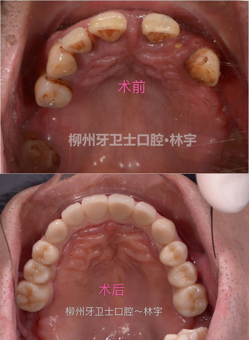 种植牙案例_大笨象